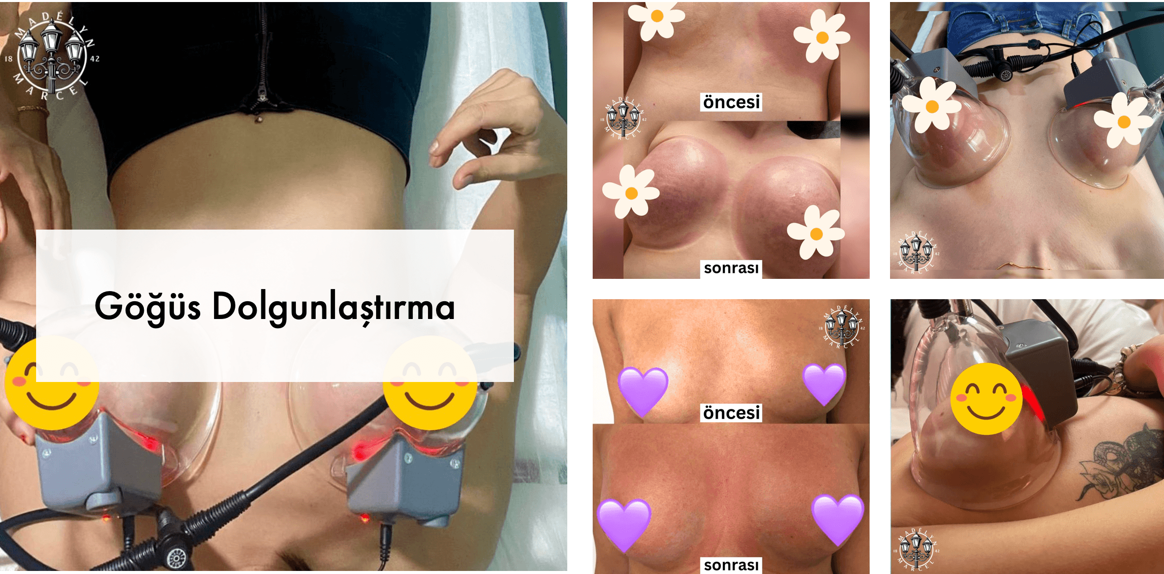 Göğüs Dolgunlaştırma
