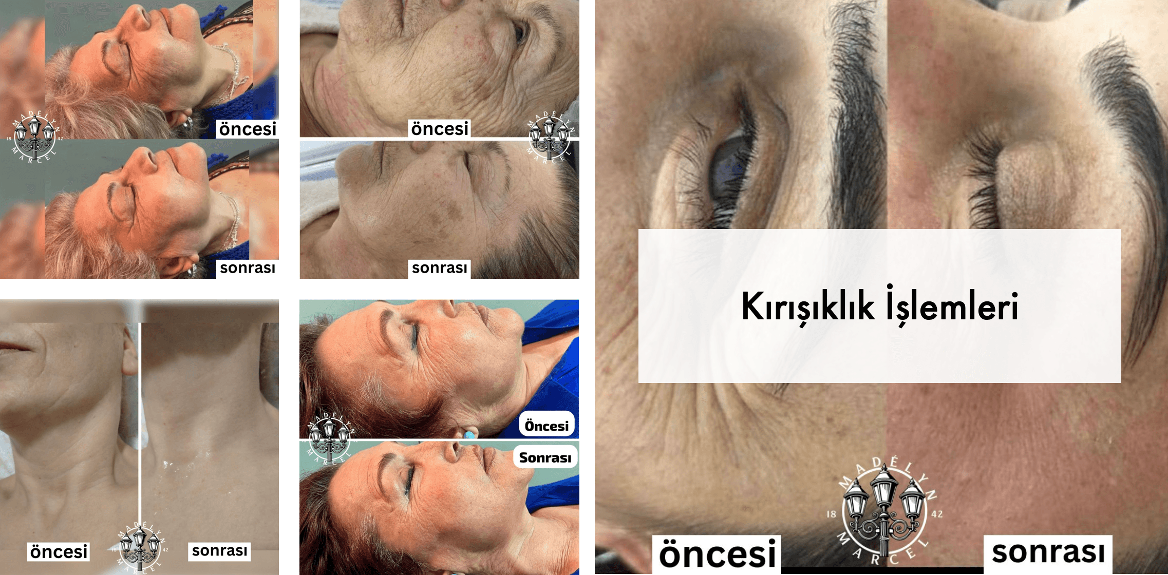 Kırışıklık İşlemleri